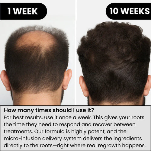 Nexurainsert™ Hair Regrowth System